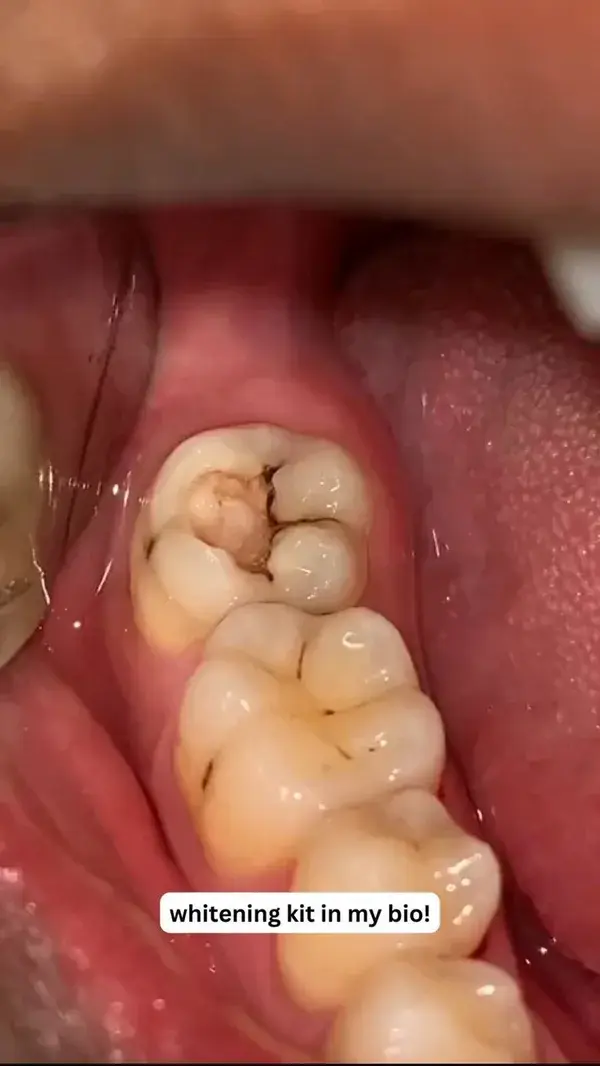 Cavity Cleaning