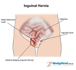 What Is Inguinal Hernia? Causes, Symptoms & Treatment Options