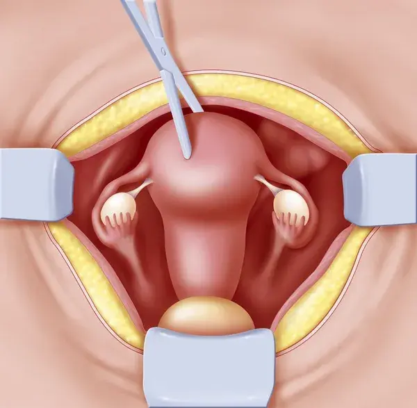 Hysterectomy: Recovery
