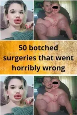 50 botched surgeries that went horribly wrong