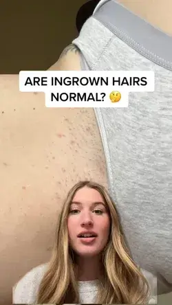 Are Ingrown Hairs Normal?