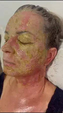 Já ouviu falar do Peeling de fenol ?