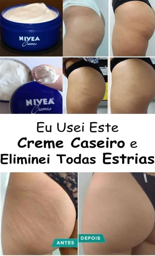 Cómo hacer cremas caseras para las estrías