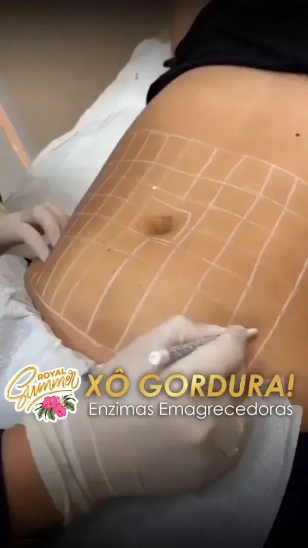 ¡Eliminar estrías y celulitis ahora o nunca!