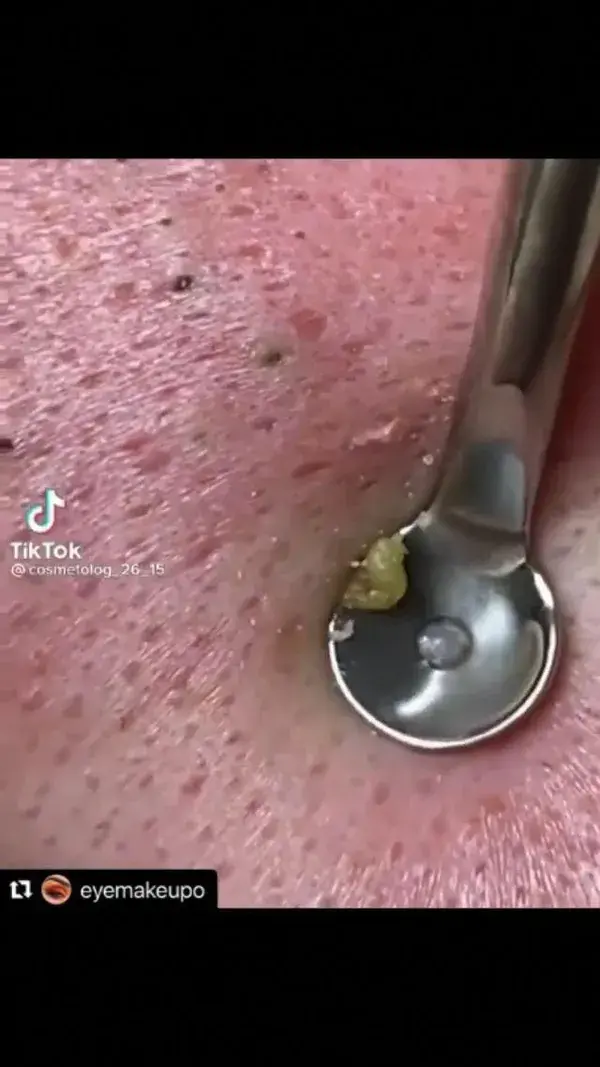 Blackheads removal so satisfying