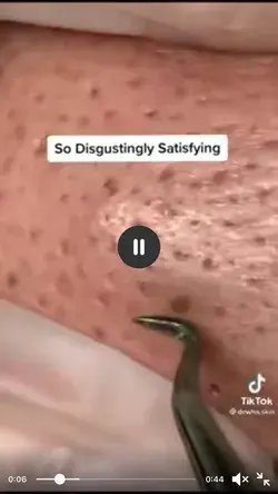 Blackheads extraction satisfying