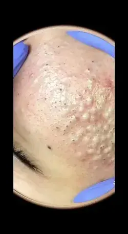 Blackheads