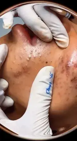 Blackheads