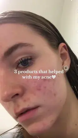 3 products that helped with my acne