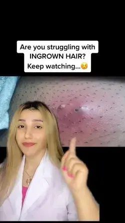 How to get rid of ingrown hair