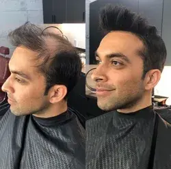 Before and after comparison with thins skin Toupee