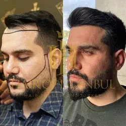 FUE Hair and Beard Transplant Before and After