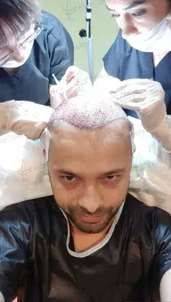 At the hair transplant operation