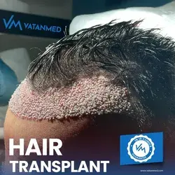 VatanMed Hair Transplant