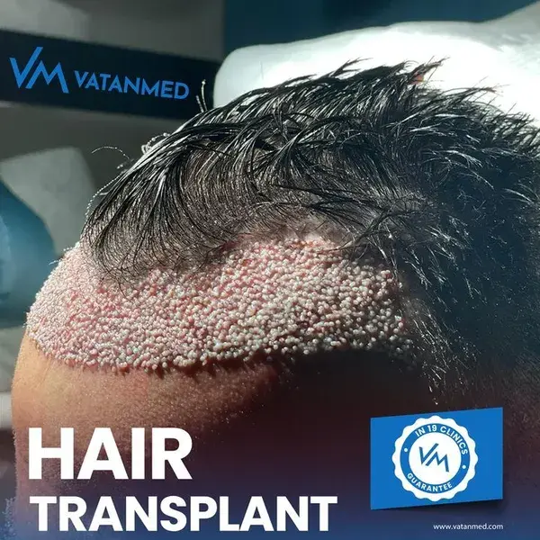 VatanMed Hair Transplant