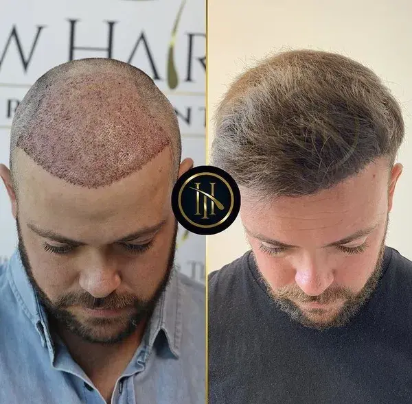 Hair Transplant Before and After