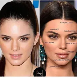 How to become an instagram model? Kendal Jenner before and after surgery 