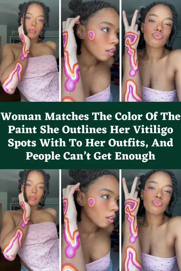 Woman Matches The Color Of The Paint She Outlines Her Vitiligo Spots With To Her Outfits,