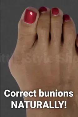 Correct Bunions Naturally!