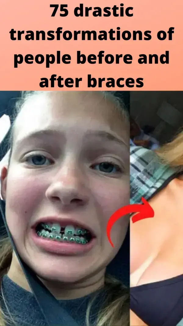 75 drastic transformations of people before and after braces