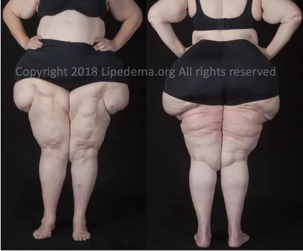 www.lipedema.org