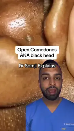 Open Comedones AKA black head