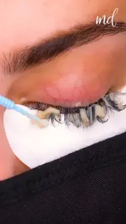 EYELASH REMOVAL