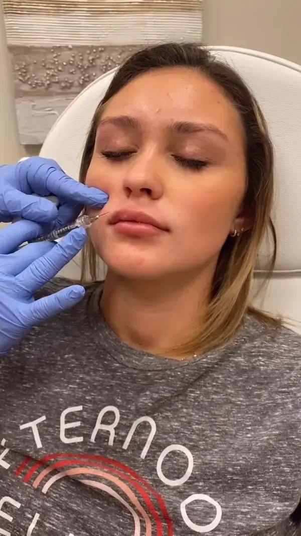 Lip Filler Experience