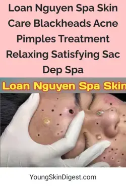 Loan Nguyen Spa Skin Care Blackheads Acne Pimples Treatment Relaxing Satisfying Sac Dep Spa