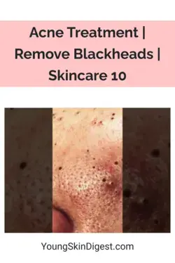 Acne Treatment | Remove Blackheads | Skincare 10