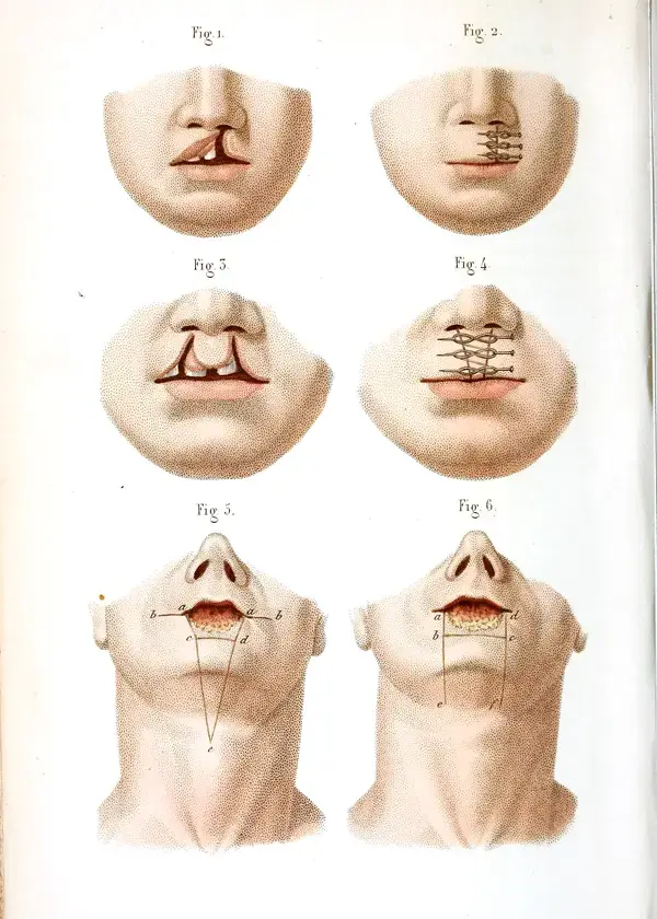 Early plastic surgery Vintage Illustration 