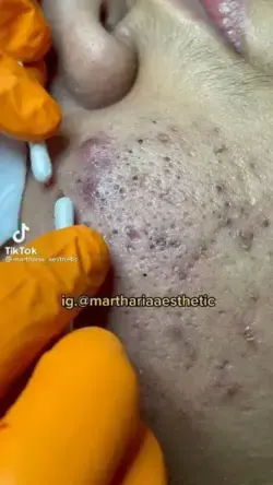 blackhead removal