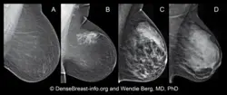 densebreast-info.org