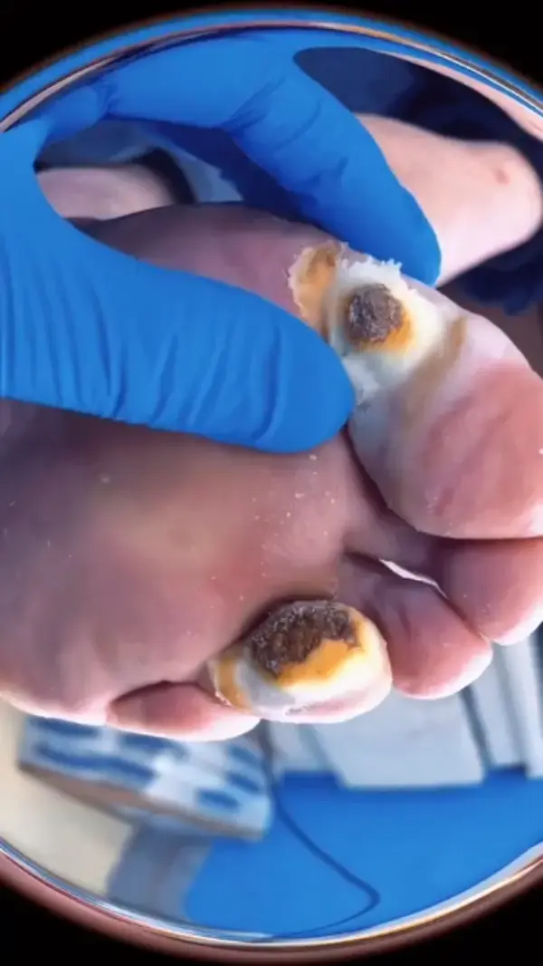 The #1 Best Foot Fungus Remedy for at Home, Get Rid Of Athletes Foot, Improve Nail and Skin Health