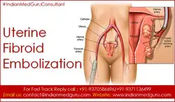 Uterine Fibroid Embolization India: Things to Know While Choosing This Surgery