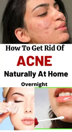 20+ Natural Proven Way to Get Rid Of Acne Overnight - Beauty And Lifestyle Blog