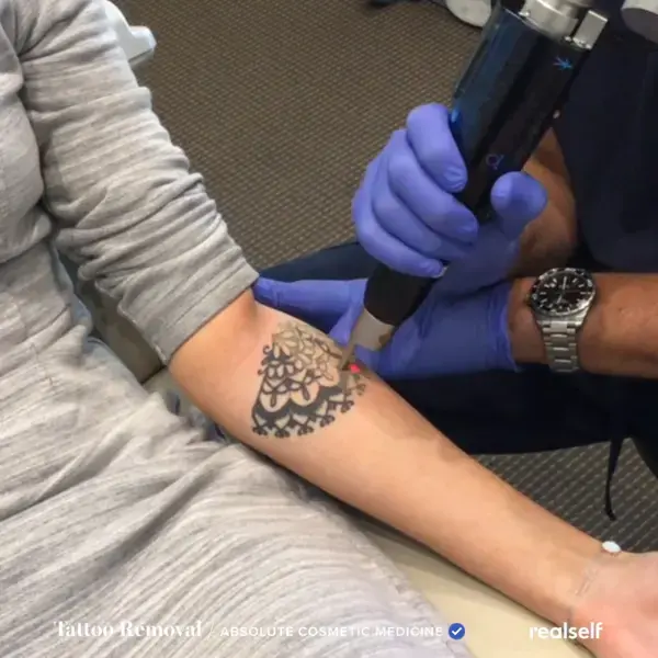 What tattoo removal really feels like