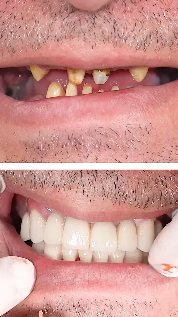 Total teeth transformation