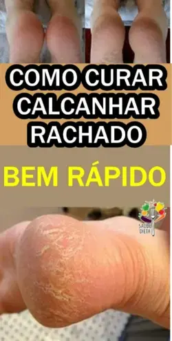 Como Cuidar das Rachadura nos Pés De Forma Simples