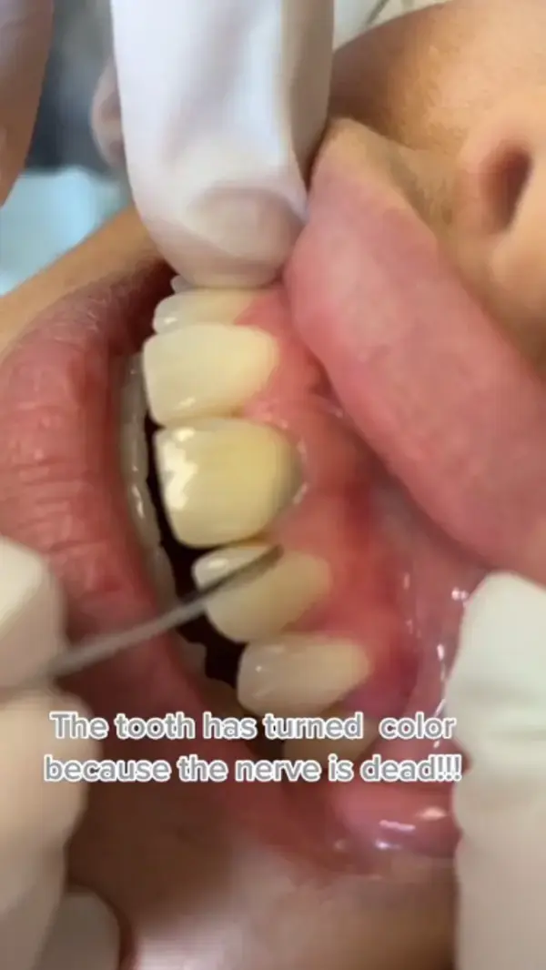 Teeth Cleaning, Teeth Whitening Hack, Oral Hygiene, Whiten Teeth at Home, Improve Oral Health