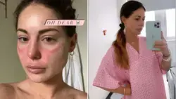 Louise Thompson reveals she has lupus as she suffers nasty rash and shares health update