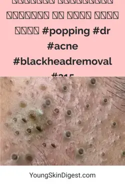 𝗘𝘅𝘁𝗿𝗲𝗺𝗲 𝗕𝗹𝗮𝗰𝗸𝗵𝗲𝗮𝗱 𝗥𝗲𝗺𝗼𝘃𝗮𝗹 𝗮𝘁 𝗡𝗔𝗦𝗔 𝗦𝗸𝗶𝗻 𝗖𝗮𝗿𝗲  #popping #dr #acne #blackheadremoval #315