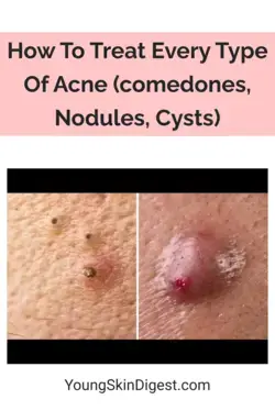How To Treat Every Type Of Acne (comedones, Nodules, Cysts)