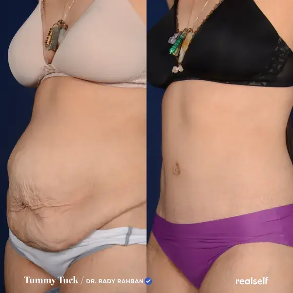 12 Things I Wish I Knew Before My Tummy Tuck