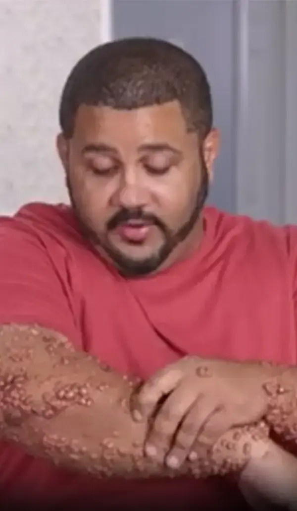 Man with ‘stone-like’ bumps covering 90% of his arms insists they don’t hurt as he pulls on and s...