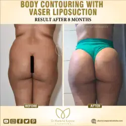 Body Contouring With Vaser Liposuction in India