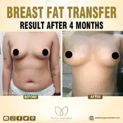 Embrace Your Natural Beauty: Achieve Non-Surgical Breast Augmentation with Your Own Fat Transfer|