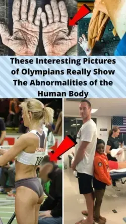 These Interesting Pictures of Olympians Really Show The Abnormalities of the Human Body