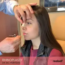 9 Things I Wish I'd Known Before Rhinoplasty