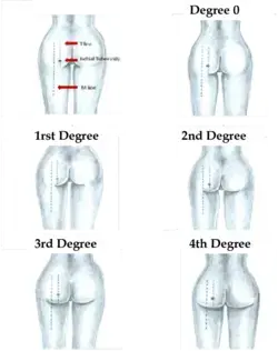 Is it an hourglass shape, or is it just gluteal ptosis?